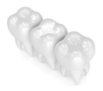3d render of teeth with white composite filling over white background