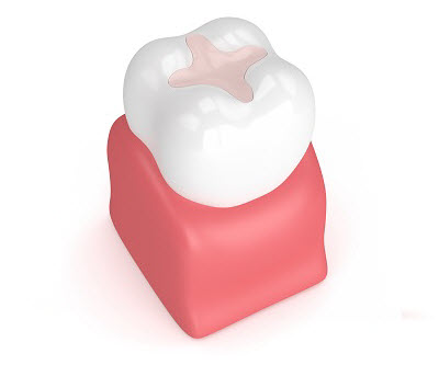 3D render of dental filling