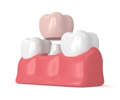 3D render of dental crown
