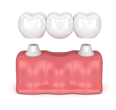 3d render of dental bridge with dental crowns in gums isolated over white background